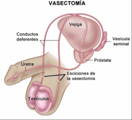 12-1.vasectomía_