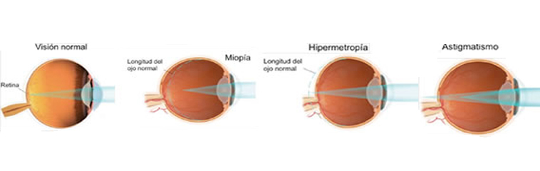 miopia hipermetropia astigmatismo diferencias)