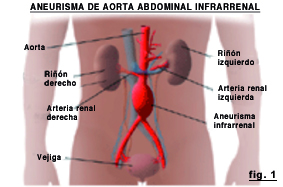 
en aneurisma
abdominal
