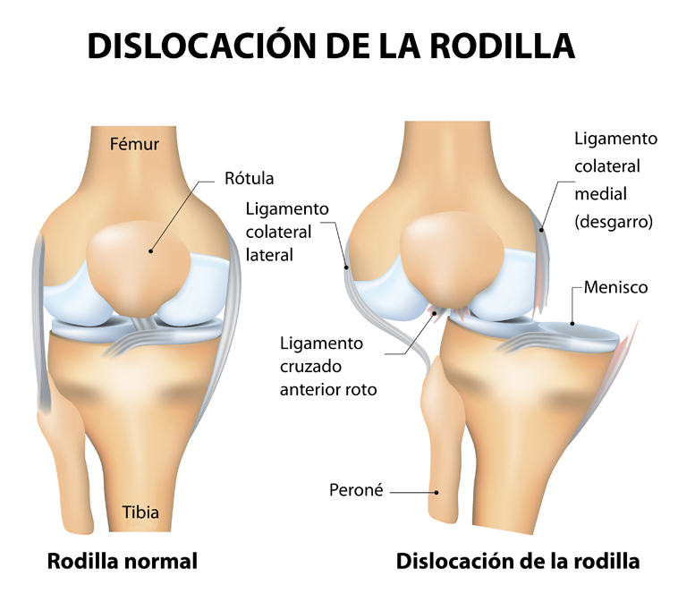 Knee dislocation and normal. Lateral trauma to the knee, torn collateral ligaments, cruciate ligament injury and meniscus injury. Human anatomy