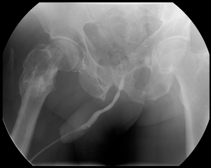 Imagen 1- Estenosis uretral diagnosticada por uretrografía retrógrada