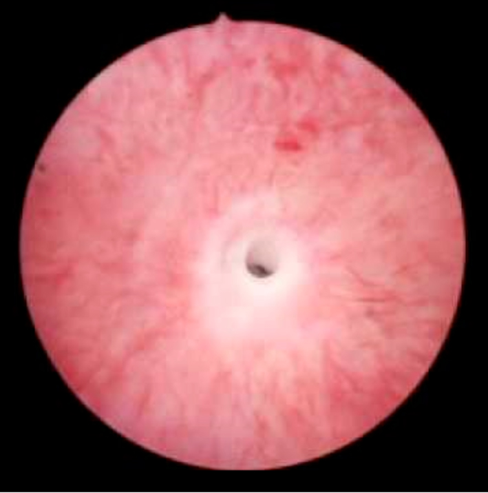 Imagen 2- Estenosis uretral en su visión endoscópica mediante la técnica de uretrocistoscopia.