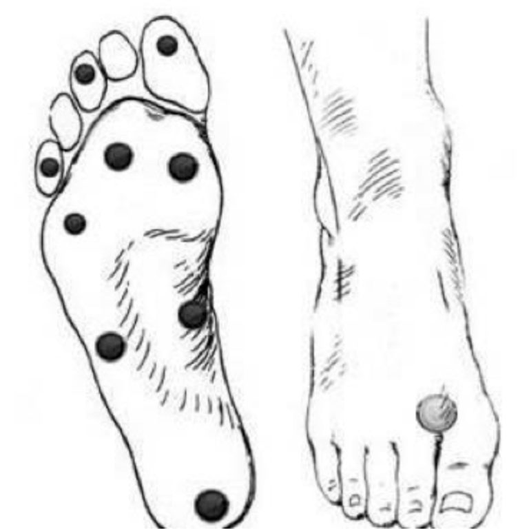 Exploración sensorial del pie diabético test del monofilamento Zona