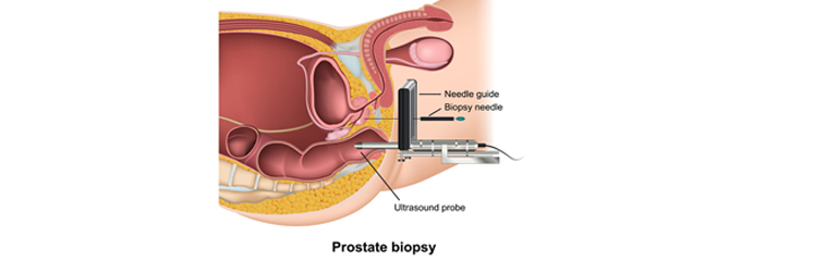 cuidados después de una biopsia de próstata