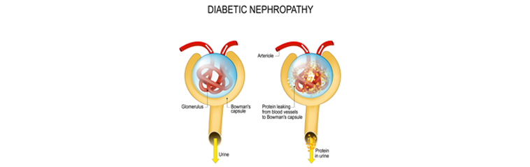 nefropatía diabética establecida