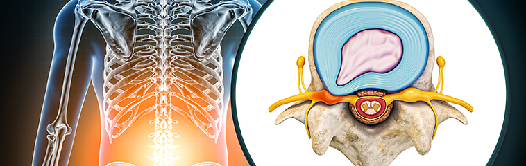 <h1 class='entry-title h2-style'>Hernia discal lumbar: una guía clara para entenderla y afrontarla</h1><div id='b' style='margin-bottom: 10px;'> <span class='sb'><br><strong>César Muñiz Argüelles y Bakarne Apaolaza Bereciartu</strong>. Médicos Internos Residentes de Anestesiología, Reanimación y Terapéutica del Dolor. Hospital Universitario de Navarra. <strong>Carla Lobón Jiménez</strong>. FEA Anestesiología, Reanimación y Terapéutica del Dolor. Hospital Universitario de Navarra</span></b>