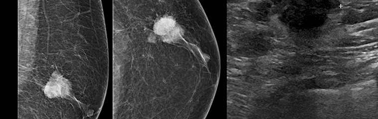 <h1 class='entry-title h2-style'>Cáncer de mama en hombres</h1><div id='b' style='margin-bottom: 10px;'> <span class='sb'><br><strong>Mikel Sánchez González.</strong> Técnico Especialista en Radiodiagnóstico. Hospital Universitario de Navarra </span></b>