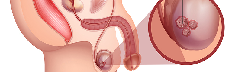 <h1 class='entry-title h2-style'>Tumor testicular: qué es y cómo se trata</h1><div id='b' style='margin-bottom: 10px;'> <span class='sb'><br><strong>Mónica Sanz del Pozo, Ángel García de Jalón Martínez, Raquel Espílez Ortiz, José Manuel Sánchez Zalabardo, Pedro Gil Martínez. </strong></span></b>
