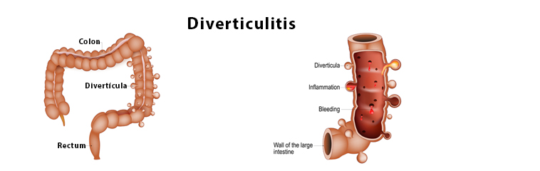 <h1 class='entry-title h2-style'>La diverticulitis aguda: guía informativa</h1><div id='b' style='margin-bottom: 10px;'> <span class='sb'><br><strong>Laura Almenara Michelena, Itziar Estrella Muelas Rives, Alba Herranz García, Cristina Nicolau Cano, Lydia García Fuentes y Jaime Monllau Espuis</strong></span></b> <h1 class='entry-title h2-style'>La diverticulitis aguda: guía informativa</h1><div id='b' style='margin-bottom: 10px;'> <span class='sb'><br><strong>Laura Almenara Michelena, Itziar Estrella Muelas Rives, Alba Herranz García, Cristina Nicolau Cano, Lydia García Fuentes y Jaime Monllau Espuis</strong></span></b>