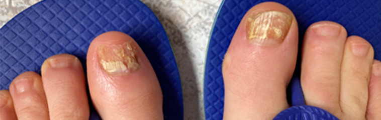 <h1 class='entry-title h2-style'>Onicomicosis: los hongos en las uñas, un problema común y tratable</h1><div id='b' style='margin-bottom: 10px;'> <span class='sb'><br><strong>Itziar Muelas Rives, Cristina Nicolau Cano, Lydia García Fuentes, Jaime Monllau Espuis, Laura Almenara Michelena, Alba Herranz García y Beatriz Clemente Hernández</strong></span></b> <h1 class='entry-title h2-style'>Onicomicosis: los hongos en las uñas, un problema común y tratable</h1><div id='b' style='margin-bottom: 10px;'> <span class='sb'><br><strong>Itziar Muelas Rives, Cristina Nicolau Cano, Lydia García Fuentes, Jaime Monllau Espuis, Laura Almenara Michelena, Alba Herranz García y Beatriz Clemente Hernández</strong></span></b>