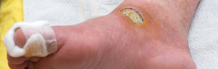 <h1 class='entry-title h2-style'>Úlceras de presión</h1><div id='b' style='margin-bottom: 10px;'> <span class='sb'><br><strong>Andrea Palacios Aznar.</strong> TCAE. Hospital Ntra. Sra. De Gracia.<strong> Nuria Aznar Hernández.</strong> TCAE. Hospital Ntra. Sra. De Gracia.</span></b>