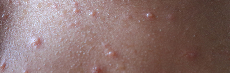 <h1 class='entry-title h2-style'>España pierde el reconocimiento de país libre de sarampión. De la alerta a la prevención</h1><div id='b' style='margin-bottom: 10px;'> <span class='sb'><br><strong>Ana García de Galdiano Fernández.</strong> Enfermera Medicina Preventiva HUN.<strong> Manuel Requena Parra y Judith Chamorro Camazón.</strong> FEA Medicina Preventiva y Salud Pública Unidad de vacunación. Servicio Medicina Preventiva. HUN</span></b> <h1 class='entry-title h2-style'>España pierde el reconocimiento de país libre de sarampión. De la alerta a la prevención</h1><div id='b' style='margin-bottom: 10px;'> <span class='sb'><br><strong>Ana García de Galdiano Fernández.</strong> Enfermera Medicina Preventiva HUN.<strong> Manuel Requena Parra y Judith Chamorro Camazón.</strong> FEA Medicina Preventiva y Salud Pública Unidad de vacunación. Servicio Medicina Preventiva. HUN</span></b>