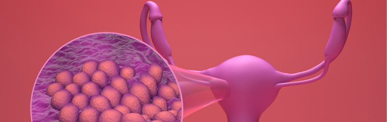 <h1 class='entry-title h2-style'>Cáncer de endometrio</h1><div id='b' style='margin-bottom: 10px;'> <span class='sb'><br><strong>Piedad Fleta Cubero, Mercedes Alonso Bueno, Juan Bosque Julián, María Jesús Gómez Martín, Ana Isabel Sesma García, Ana Belén Mateo Lafuente, Diego Calvo Tesan</strong></span></b>